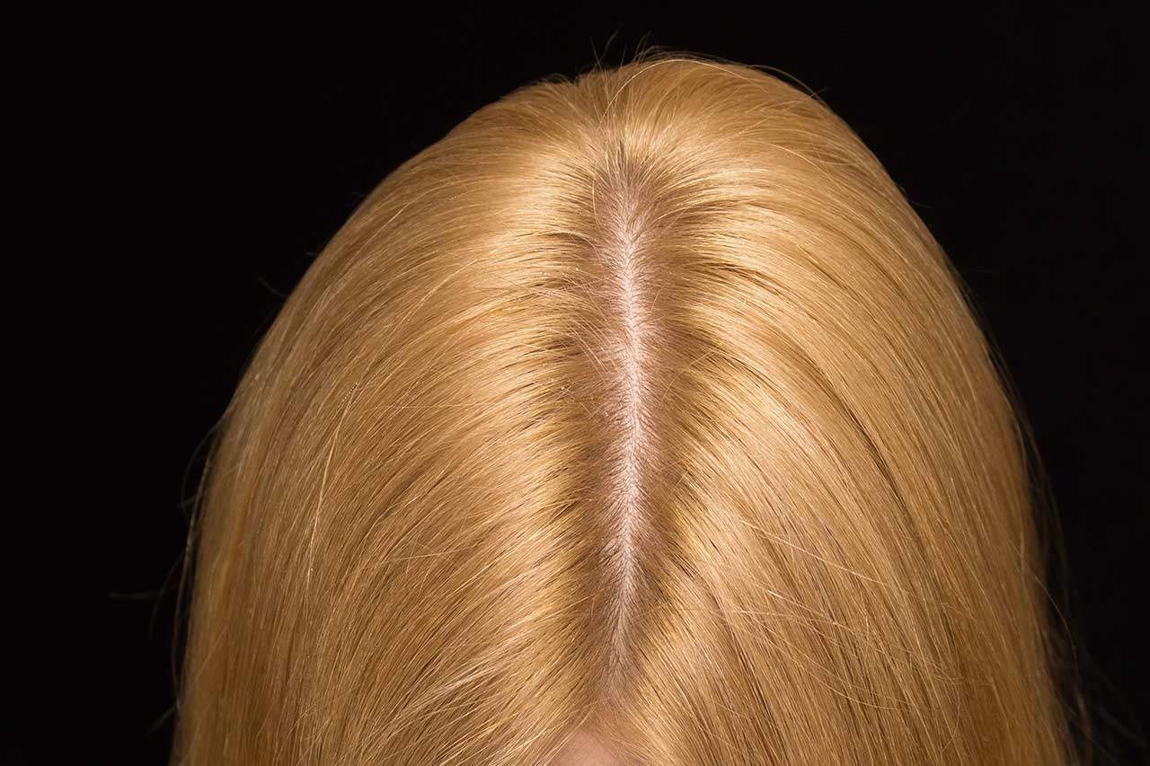 scalp care consulting