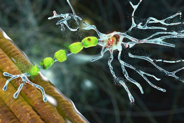 multiple sclerosis causes treatments conseil consulting