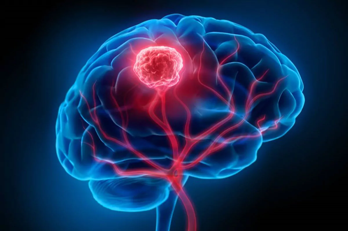 cure innovative tumori cerebrali agenzia consulenza consulting esperti
