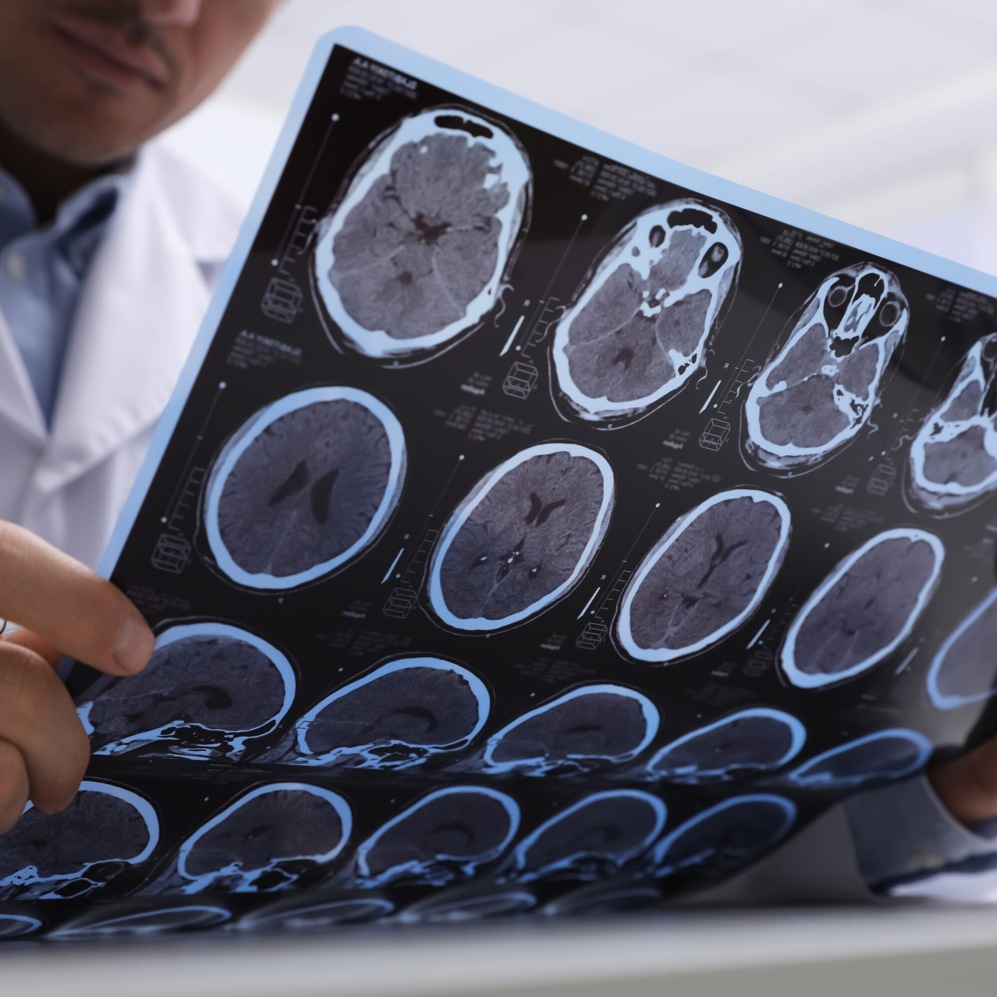 covid long alzheimer agence conseil consulting cabinet